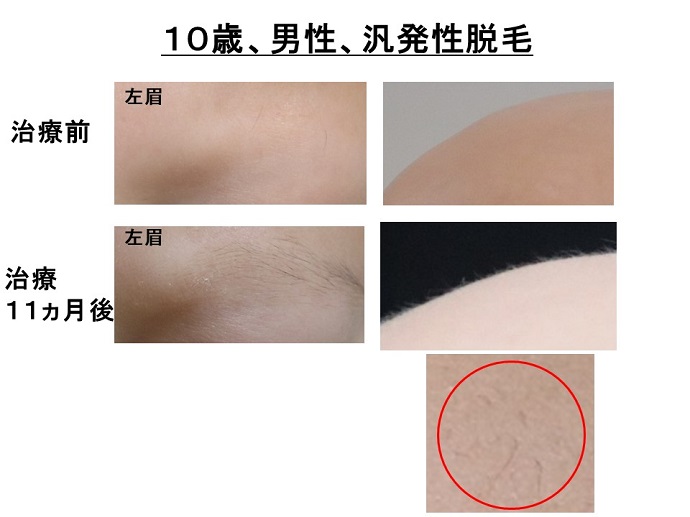 円形脱毛症　病院